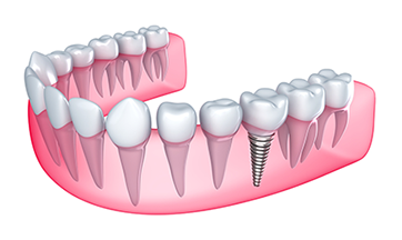 Dental Implants in Two Rivers, WI